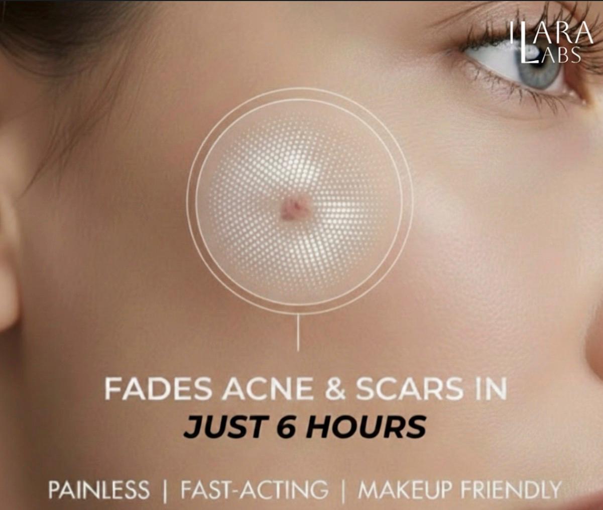Microneedle Acné Patches